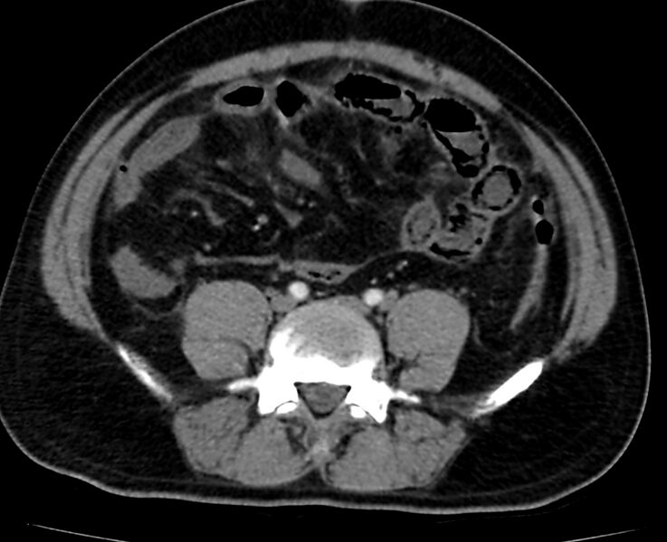 File:Acute mesenteric ischemia - superior mesenteric artery thrombosis (Radiopaedia 73947-84776 Axial C+ arterial phase 103).jpg