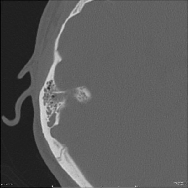 File:Acute otomastoiditis (Radiopaedia 28276-28512 Axial PTB bone window reformat 19).jpg