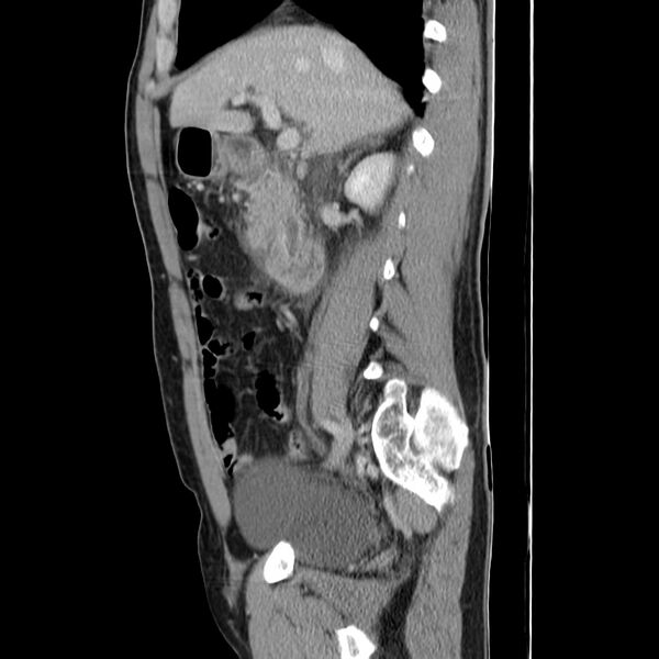 File:Acute pancreatitis (Radiopaedia 22572-22596 Sagittal C+ portal venous phase 21).jpg