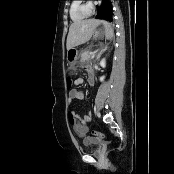 File:Acute pancreatitis (Radiopaedia 69236-79012 Sagittal C+ portal venous phase 45).jpg