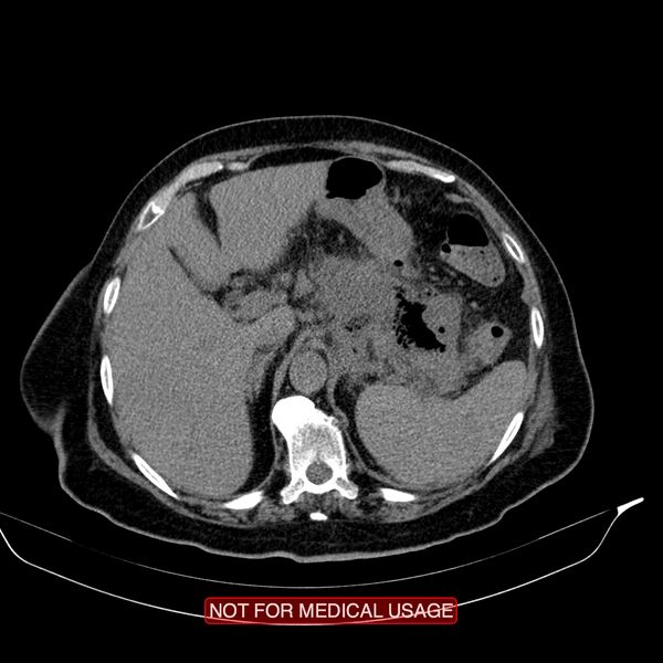 File:Acute pancreatitis with infected necrosis (Radiopaedia 26454-26585 Axial non-contrast 6).jpg