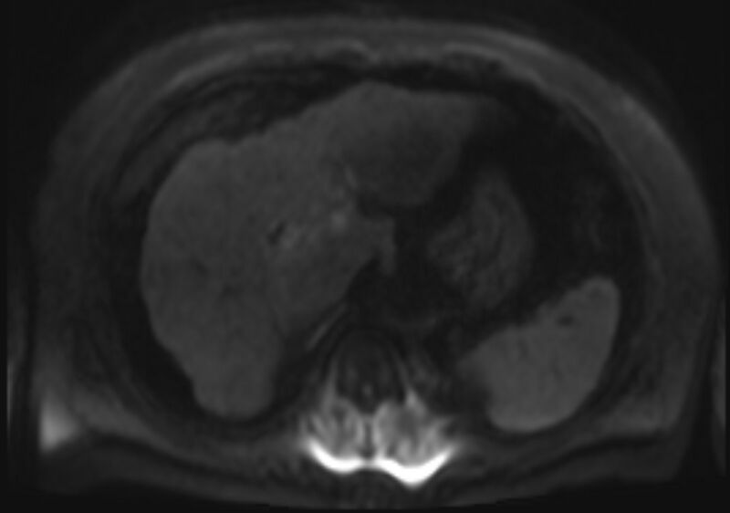 File:Acute portal vein thrombosis (Radiopaedia 73198-83925 Axial DWI 42).jpg