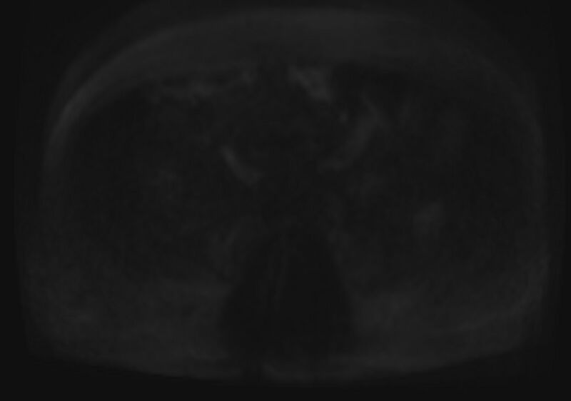 File:Acute portal vein thrombosis (Radiopaedia 73198-83925 Axial DWI 89).jpg