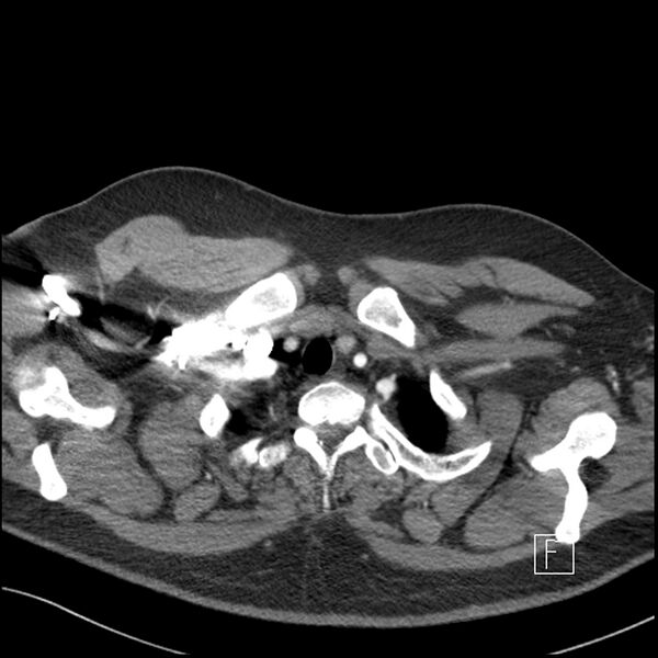 File:Acute pulmonary embolism with pulmonary infarct (Radiopaedia 73062-83768 Axial C+ CTPA 2).jpg