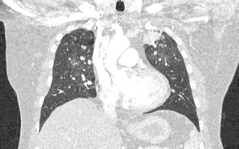 File:Acute pulmonary embolism with pulmonary infarcts (Radiopaedia 77688-89908 Coronal lung window 35).jpg