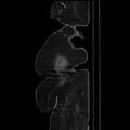 Acute pyelonephritis (Radiopaedia 25657-25837 Sagittal renal parenchymal phase 76).jpg