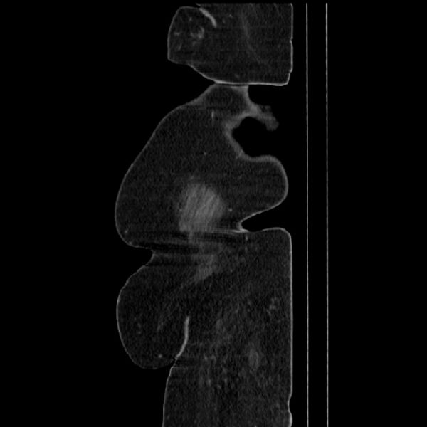 File:Acute pyelonephritis (Radiopaedia 25657-25837 Sagittal renal parenchymal phase 76).jpg