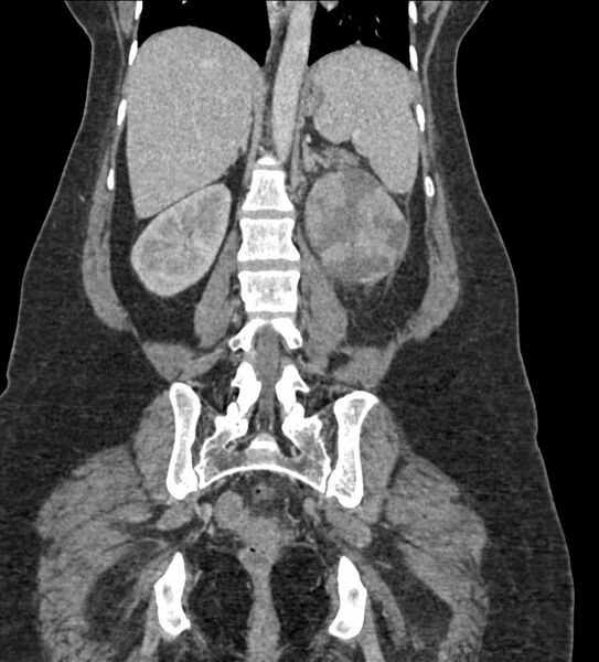 File:Acute pyelonephritis with renal vein thrombosis (Radiopaedia 58020-65053 Coronal renal parenchymal phase 78).jpg
