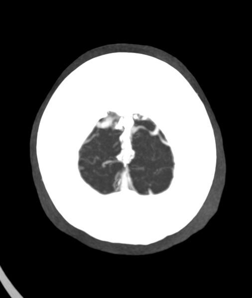 File:Acute right MCA M1 occlusion (Radiopaedia 62268-70454 Axial Phase 2 2).jpg