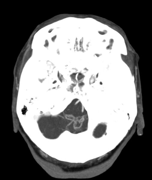 File:Acute right MCA M1 occlusion (Radiopaedia 62268-70454 Axial Phase 2 24).jpg