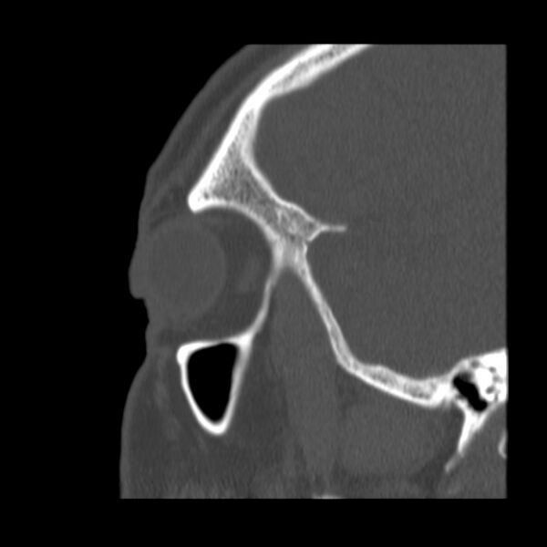 File:Acute sinusitis (Radiopaedia 23161-23215 Sagittal bone window 53).jpg