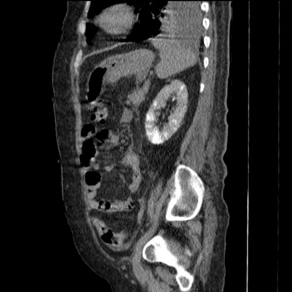 File:Acute tubular necrosis (Radiopaedia 28077-28334 H 62).jpg