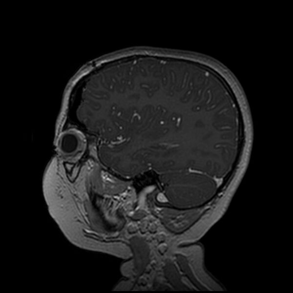 File:Adamantinomatous craniopharyngioma (Radiopaedia 77407-89529 H 32).jpg