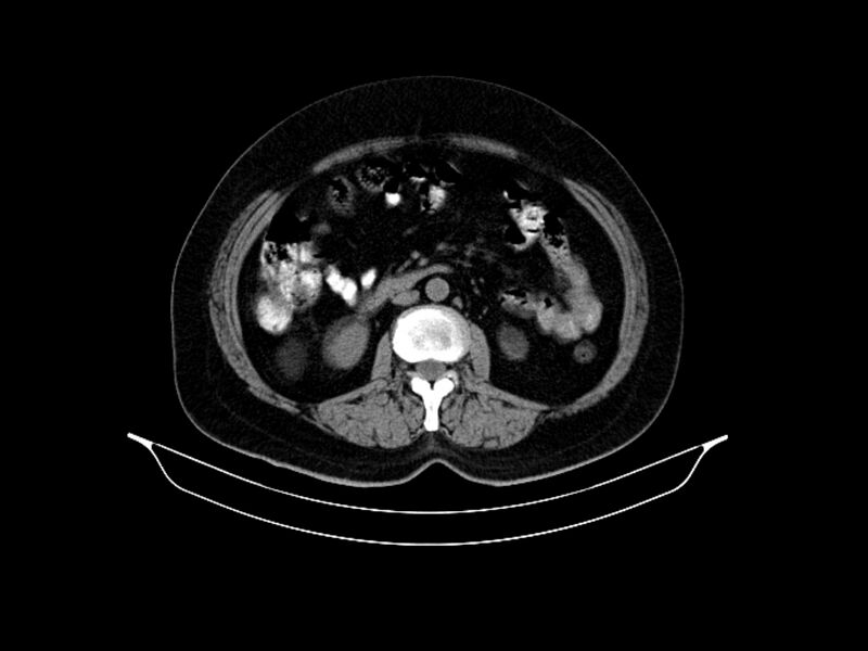 File:Adenocarcinoma of pancreas with hepatic metastasis (Radiopaedia 64332-73122 Axial non-contrast 52).jpg