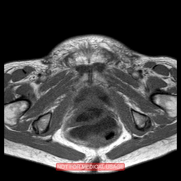 File:Adenocarcinoma of the cervix (Radiopaedia 28373-28615 Axial T1 4).jpg