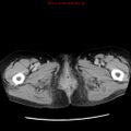 Adenocarcinoma of the colon (Radiopaedia 8191-9039 Axial renal excretory phase 69).jpg
