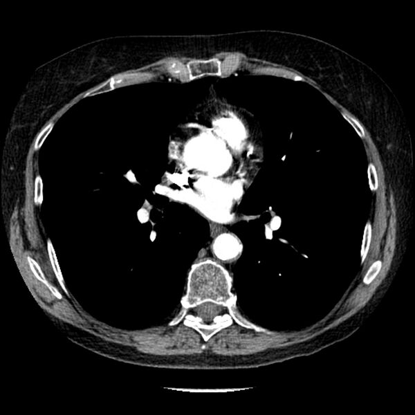File:Adenocarcinoma of the lung (Radiopaedia 41015-43755 Axial C+ portal venous phase 66).jpg
