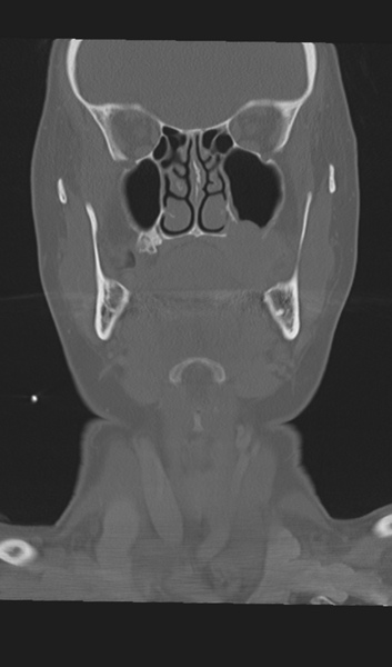 File:Adenoid cystic tumor of palate (Radiopaedia 46980-51518 Coronal bone window 26).png