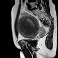 Adenomyoma of the uterus (huge) (Radiopaedia 9870-10438 Sagittal T2 4).jpg