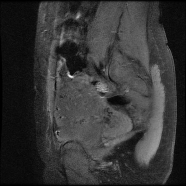 File:Adenomyosis on MRI (Radiopaedia 29328-29780 Sagittal T1 fat sat 14).jpg