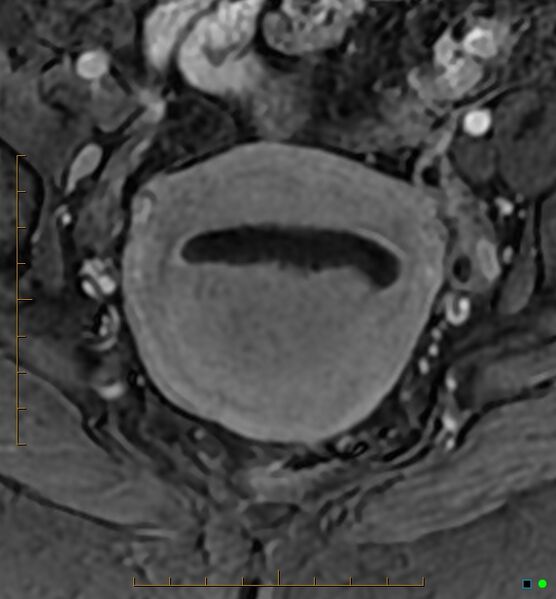 File:Adenomyosis uterus with hematometra (Radiopaedia 45779-50011 Axial T1 C+ fat sat 28).jpg