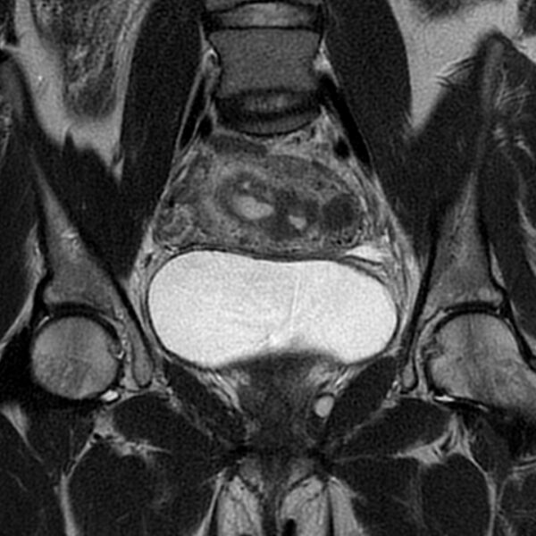 File:Adenomyosis within a septate uterus (Radiopaedia 69963-79981 Coronal T2 14).jpg