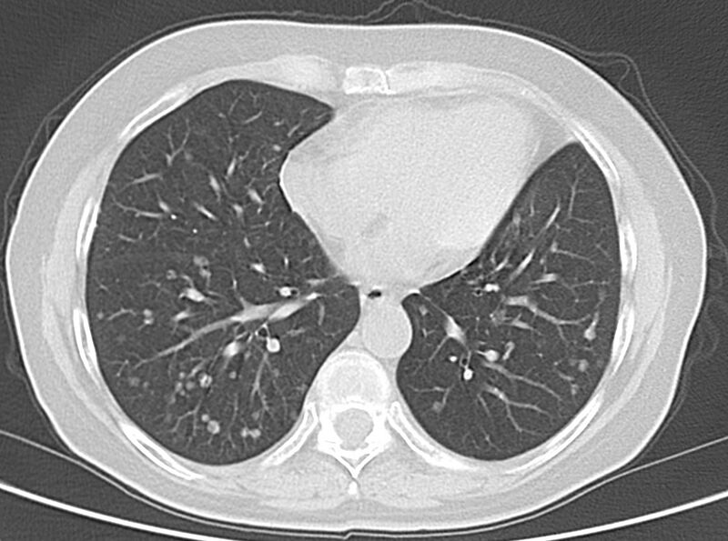 File:Adenosquamous lung carcinoma (Radiopaedia 22035-22030 lung window 40).jpg
