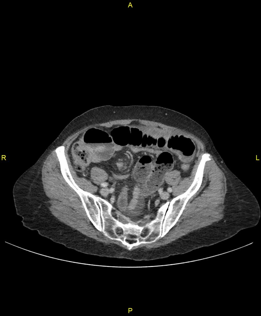 Adhesional small bowel obstruction (Radiopaedia 85402-101024 Axial C+ portal venous phase 216).jpg
