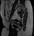 Adnexal multilocular cyst (O-RADS US 3- O-RADS MRI 3) (Radiopaedia 87426-103754 Sagittal T2 1).jpg