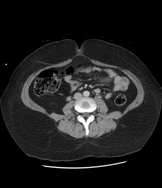 File:Adrenal cortical carcinoma with IVC invasion and thrombosis (Radiopaedia 34307-35597 Axial C+ portal venous phase 51).jpg
