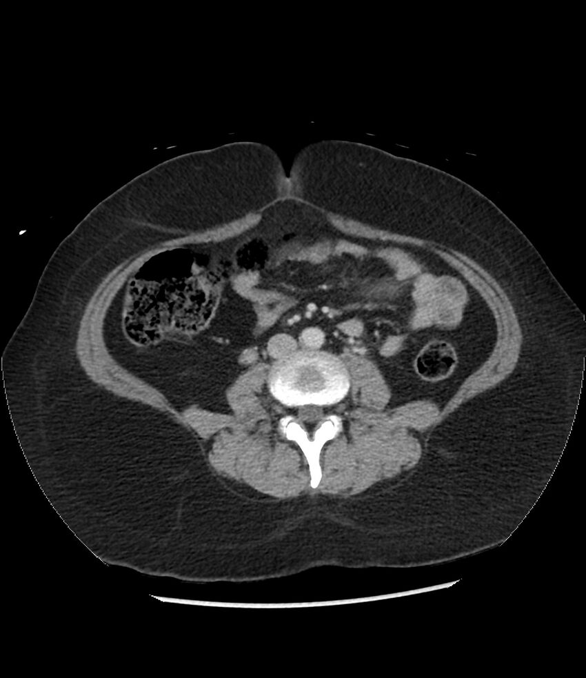 Adrenal cortical carcinoma with IVC invasion and thrombosis (Radiopaedia 34307-35597 Axial C+ portal venous phase 51).jpg