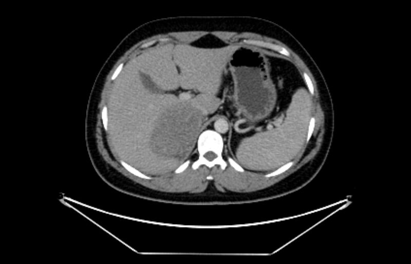 File:Adrenocortical carcinoma (Radiopaedia 80134-93438 Axial C+ portal venous phase 32).jpg
