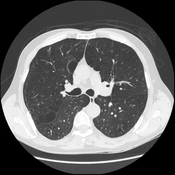 File:Alpha-1-antitrypsin deficiency (Radiopaedia 40993-43722 Axial lung window 98).jpg