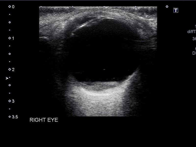 File:Amelanotic retinal melanoma (Radiopaedia 60667-68413 D 1).jpg