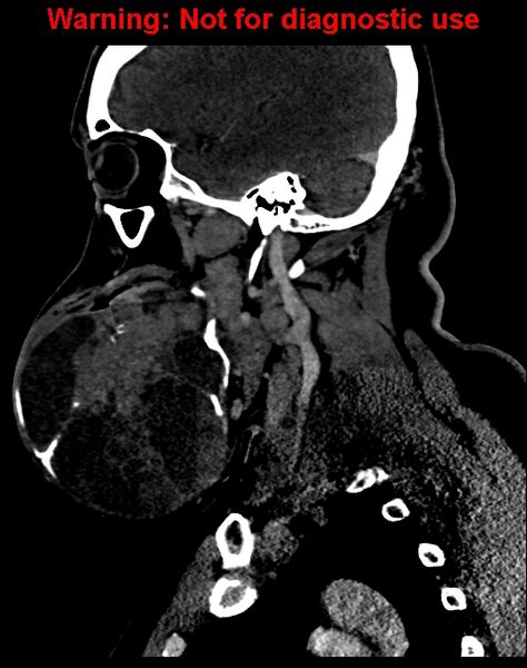 File:Ameloblastoma (Radiopaedia 33126-34164 F 24).jpg
