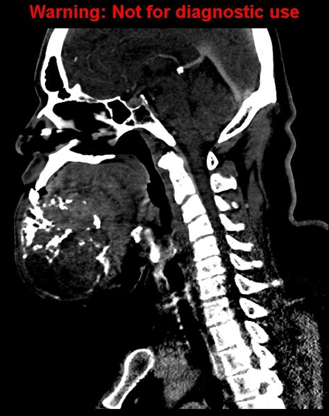 File:Ameloblastoma (Radiopaedia 33126-34164 F 36).jpg