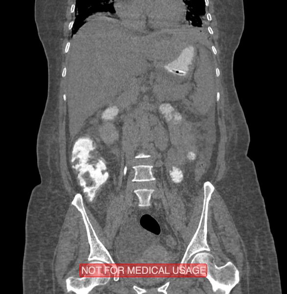 File:Amoebic enterocolitis with liver abscess (Radiopaedia 35100-36609 B 102).jpg