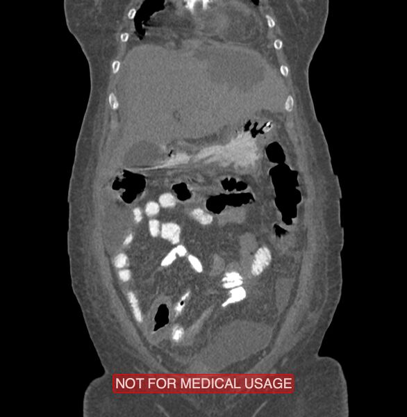 File:Amoebic enterocolitis with liver abscess (Radiopaedia 35100-36609 B 34).jpg