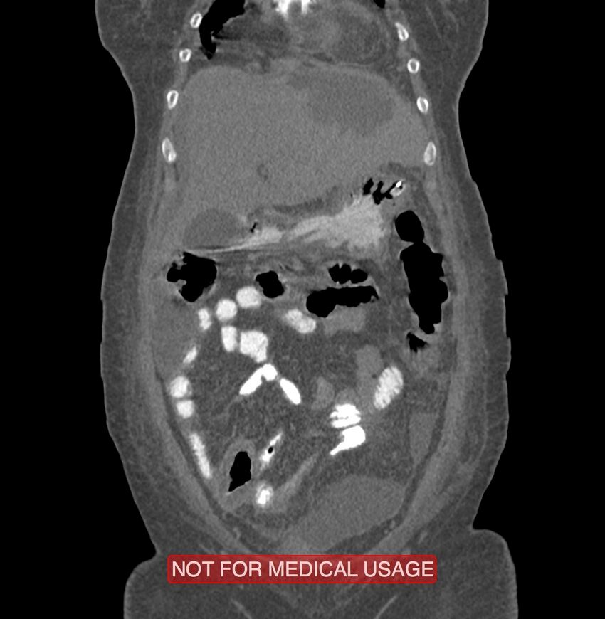 Amoebic enterocolitis with liver abscess (Radiopaedia 35100-36609 B 34).jpg