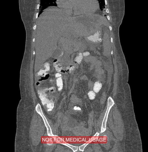 File:Amoebic enterocolitis with liver abscess (Radiopaedia 35100-36609 B 84).jpg