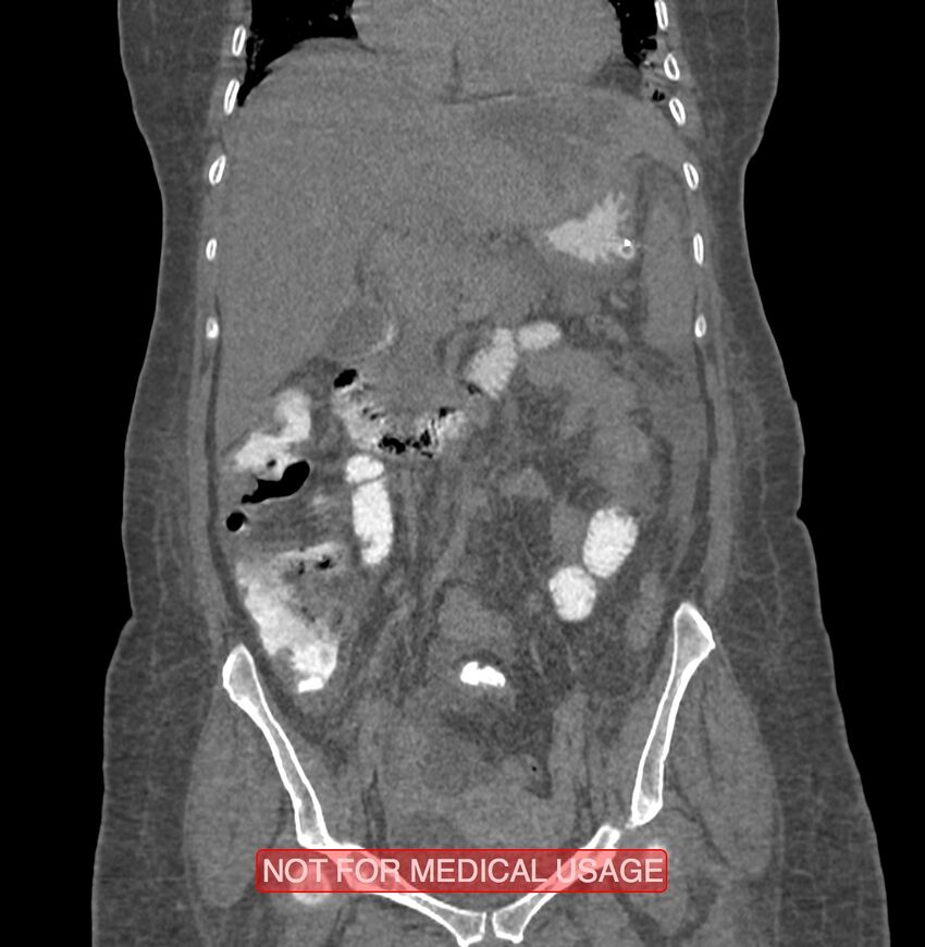 Amoebic enterocolitis with liver abscess (Radiopaedia 35100-36609 B 84).jpg