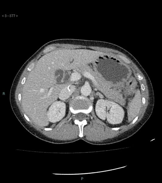 File:Ampulla of Vater metastasis (Radiopaedia 27820-28069 A 15).jpg