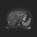 Ampullary tumor (Radiopaedia 27294-27479 T2 SPAIR 15).jpg