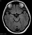 Amyotrophic lateral sclerosis (Radiopaedia 5373-7134 Axial FLAIR 10).jpg