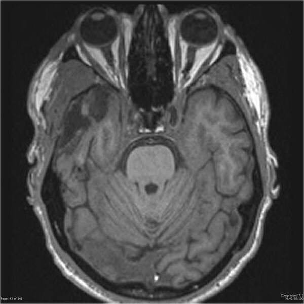 File:Anaplastic meningioma with recurrence (Radiopaedia 34452-35788 Axial T1 40).jpg