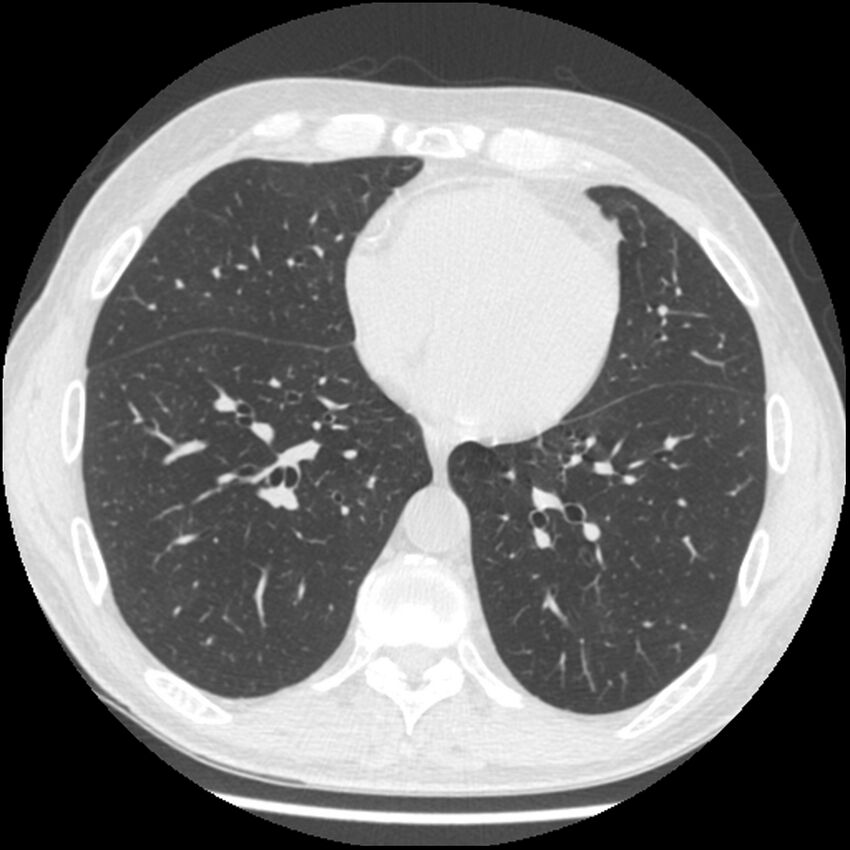 Angioinvasive aspergillosis (Radiopaedia 43957-47466 Axial lung window 44).jpg