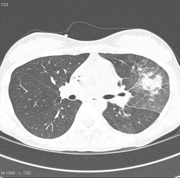 File:Angioinvasive aspergillosis (Radiopaedia 8651-9466 Axial lung window 3).jpg