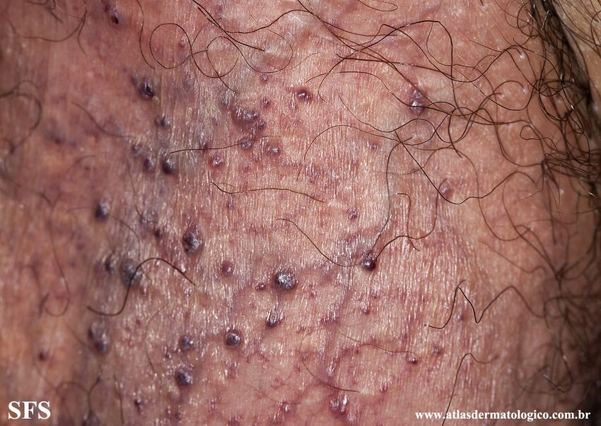 Angiokeratoma Of The Scrotum (Dermatology Atlas 14).jpg