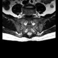 Ankylosing spondylitis with zygapophyseal arthritis (Radiopaedia 38433-40517 C 9).jpg