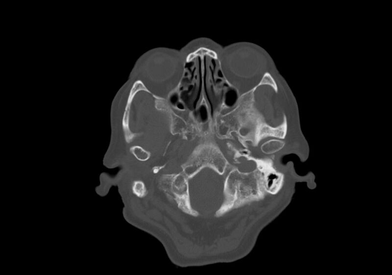 File:Anomalous intracranial venous drainage (Radiopaedia 28161-28418 Axial bone window 3).jpg